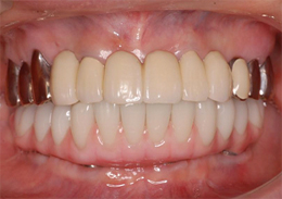 術後口腔内写真