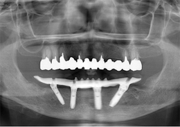 術後パノラマレントゲン写真