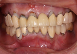 術前口腔内写真