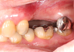 術前抜歯治癒後口腔内写真