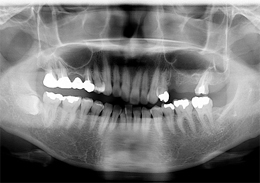 術前パノラマレントゲン写真