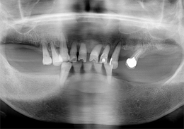 術前パノラマレントゲン写真