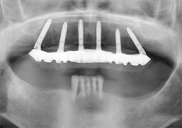 術後パノラマレントゲン写真