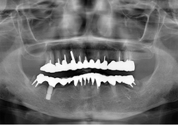 術前パノラマレントゲン写真