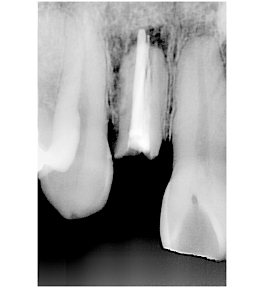 術前パノラマレントゲン写真